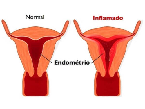 inflamacao no utero