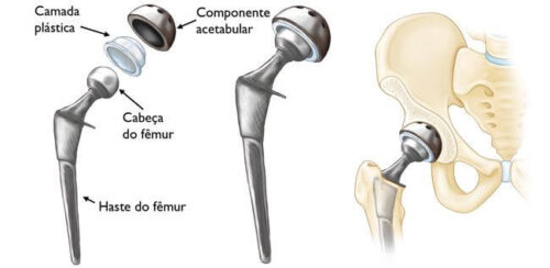 cirurgia de protese no quadril