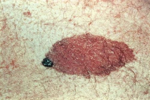 melanoma