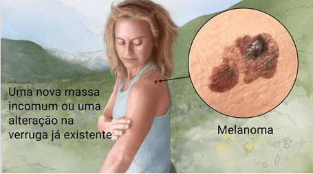 melanoma na pele