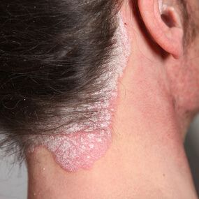 psoriase