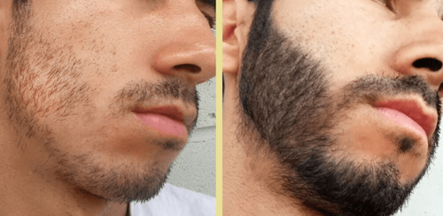 crescer barba antes e depois 2