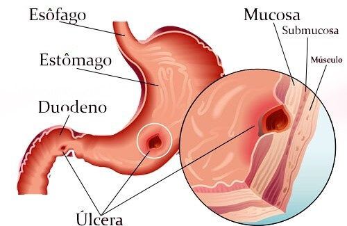 ulcera gastrica