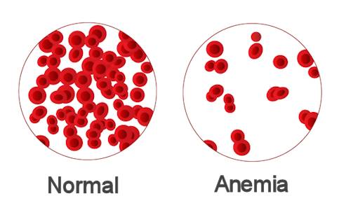 anemia