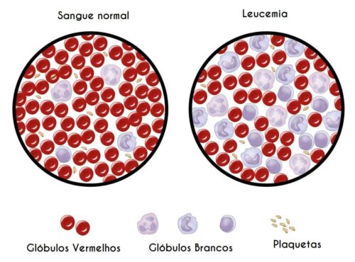 leucemia