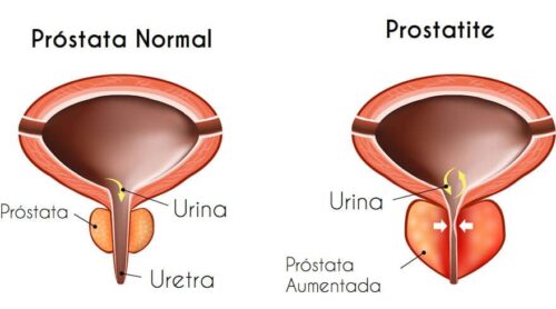 próstata normal e próstata com prostatite
