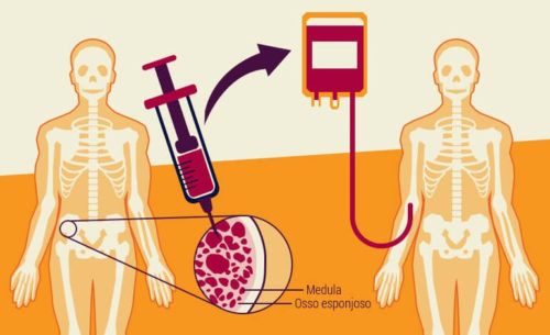 transplante de medula ossea